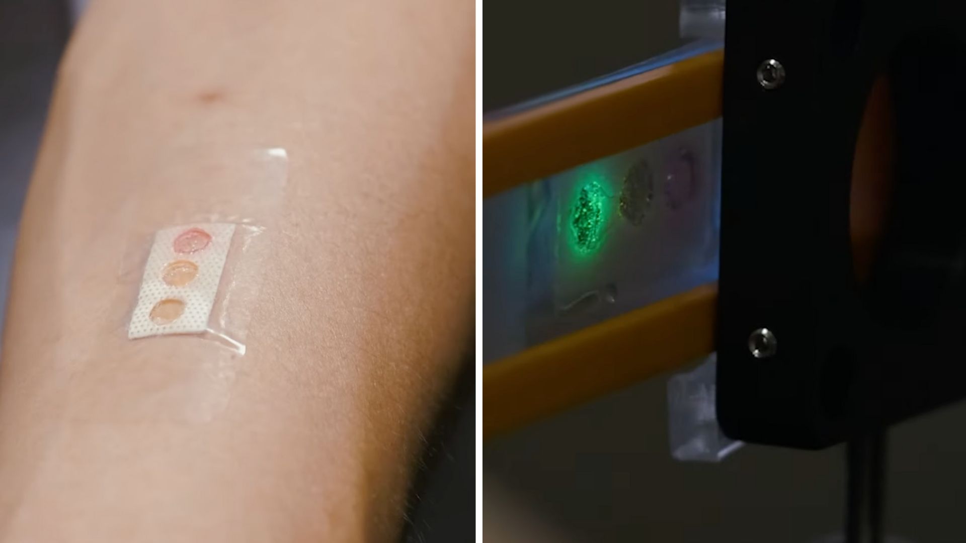 Tiny laser in band-aid tracks glucose from sweat