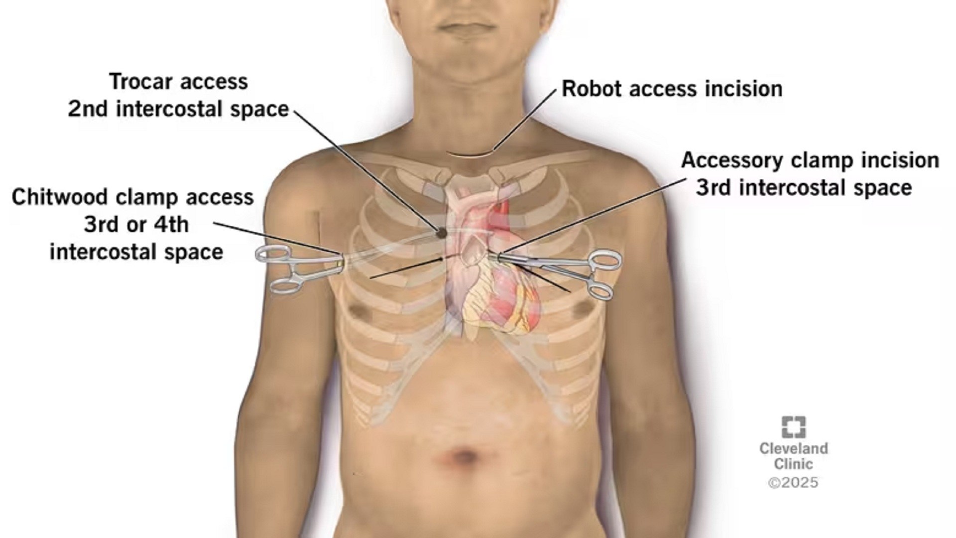 Robotic neck surgery replaces heart valve without chest incision
