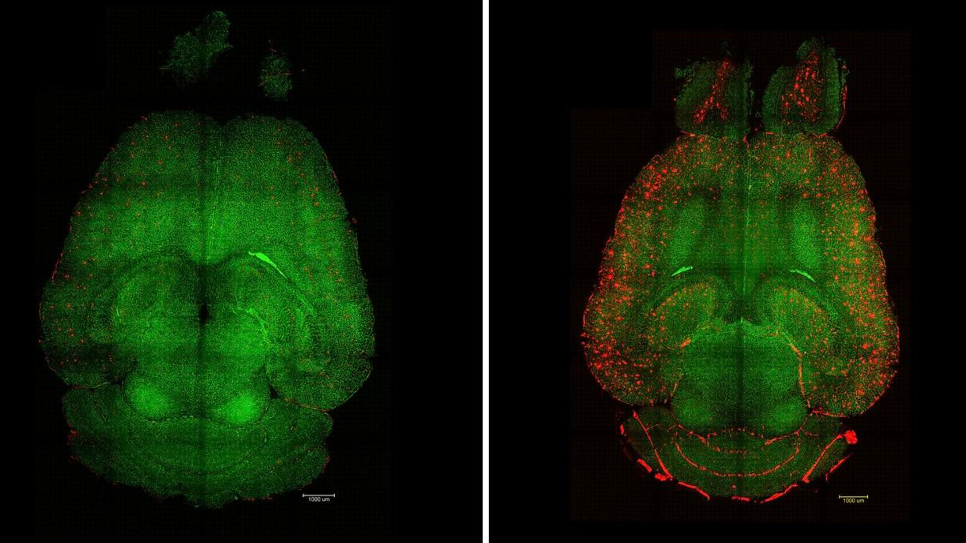 Nanoparticles repair brain barrier, reverse Alzheimer’s in mice