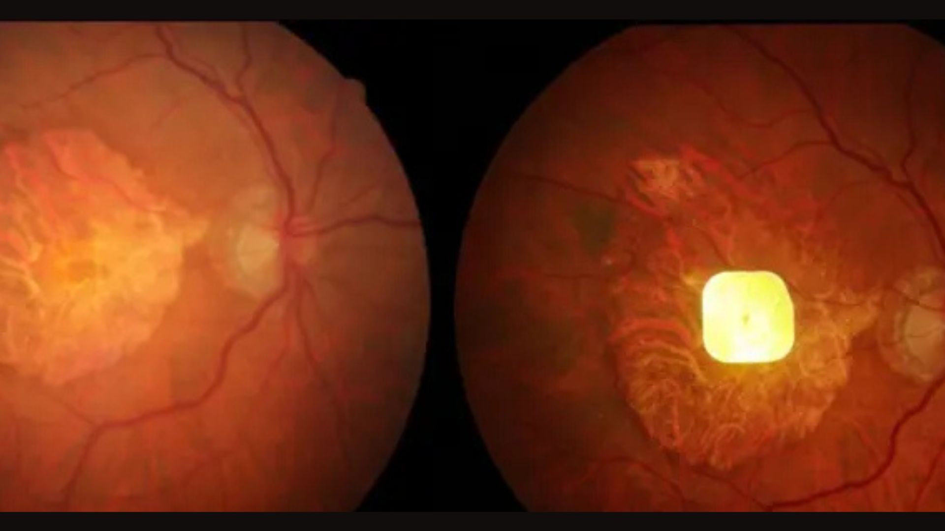 AI-powered eye implant helps blind patients read again after years without sight
