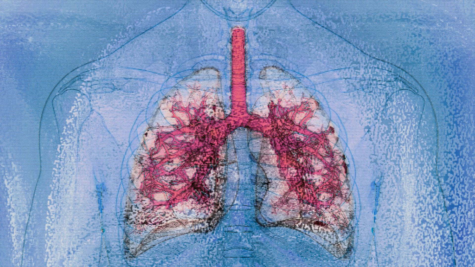 Medical miracle: World's first HIV-to-HIV dual lung and liver transplant achieved in US