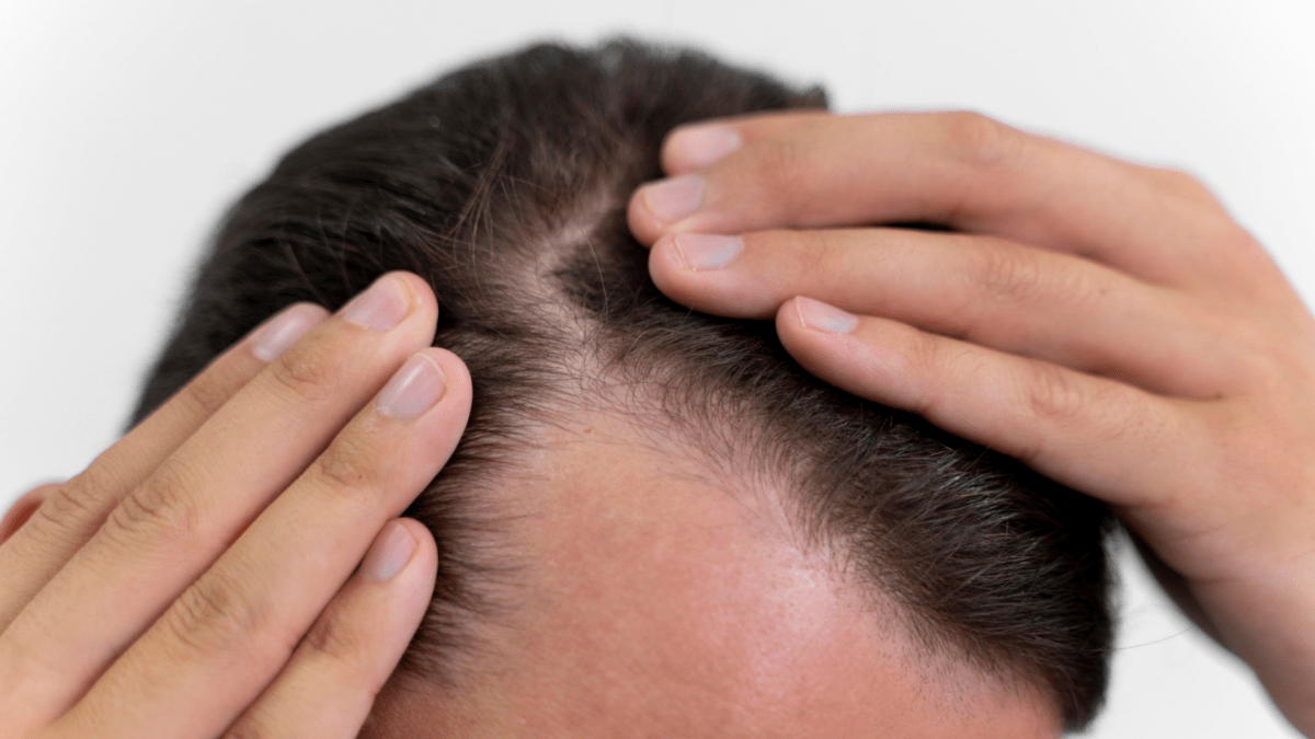 100% hair restored: Arthritis drug proves efficacy, some patients report hair regrowth in trial